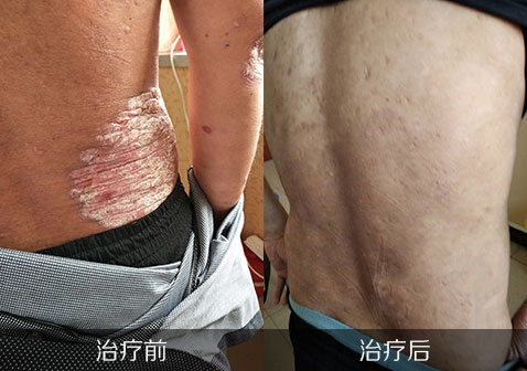 腰部银屑病治疗前后对照图片