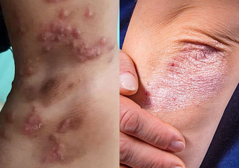 发病部位的螨虫咬疥疮和银屑病区别对比图片