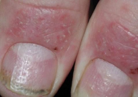 银屑病指甲初期症状图片