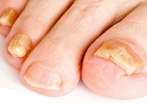银屑病指甲症状图片