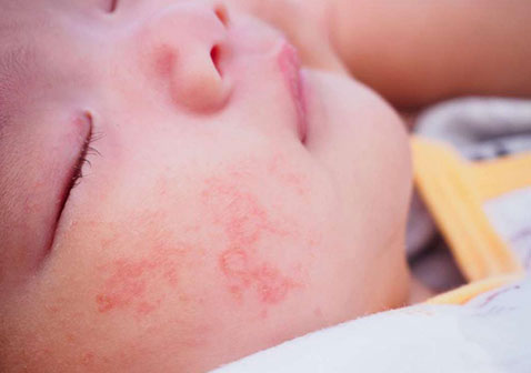 儿童脸上荨麻疹图片和症状
