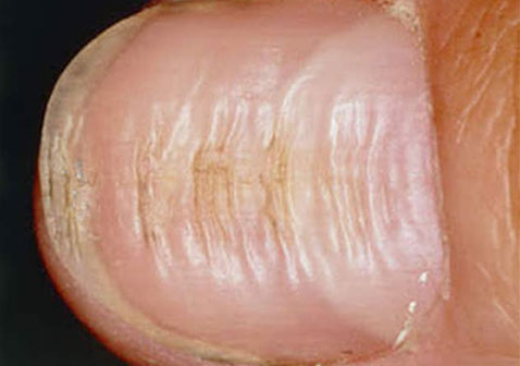 营养不良导致指甲盖凹凸不平图片