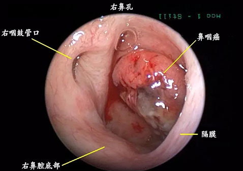 右鼻孔鼻咽癌图片