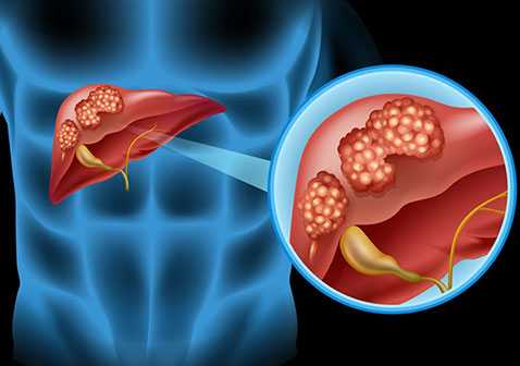 原发性肝癌是什么（附图片）