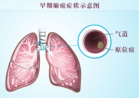 早期晚期肺癌症状图片：非小细胞肺癌，转移性肺癌症状图片