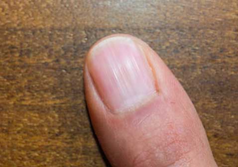 早期的灰指甲症状图片隆起的条纹