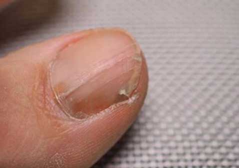 早期的灰指甲症状图片凸起条纹