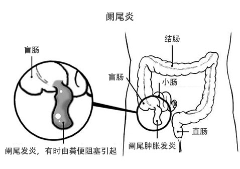 怎么判断是不是阑尾炎示意图