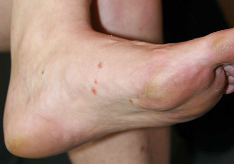 掌跖脓疱病初期症状图片脚部
