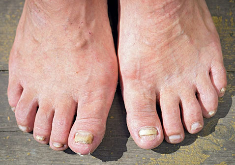 真菌感染的症状图片脚趾甲变厚变色