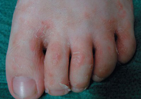 真菌性皮肤病脚癣图片