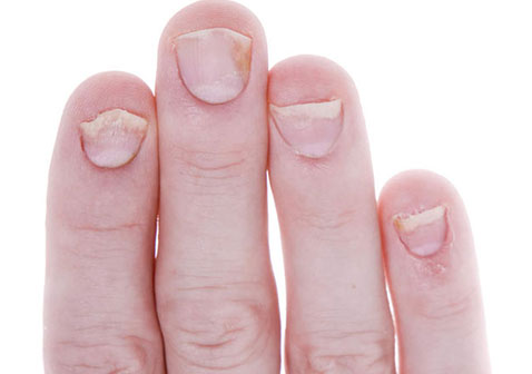 指甲银屑病初期症状图片