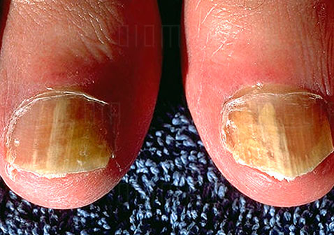 指甲真菌感染图片