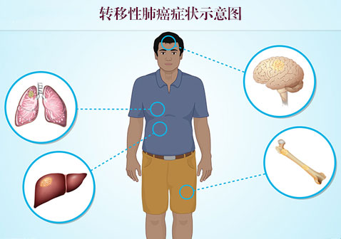 转移性肺癌症状图片