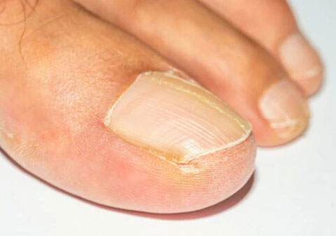 脚趾甲最轻微的灰指甲图片