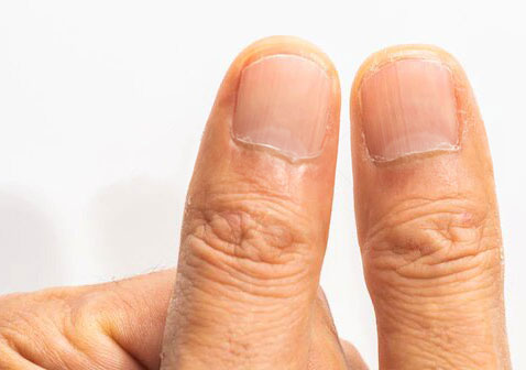 手指甲最轻微的灰指甲图片