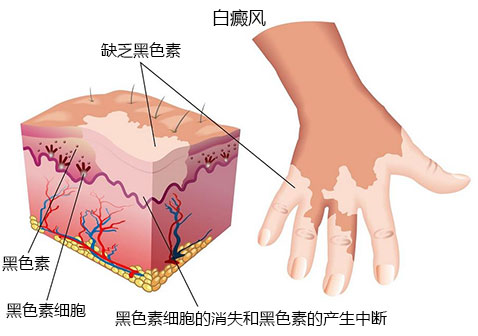 白斑病的症状示意图片