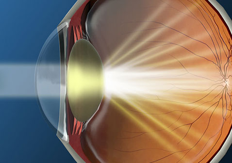 白内障的早期症状屈光不正图片