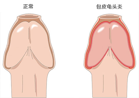 包皮龟头炎图片