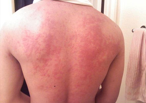 背部寒冷性荨麻疹图片