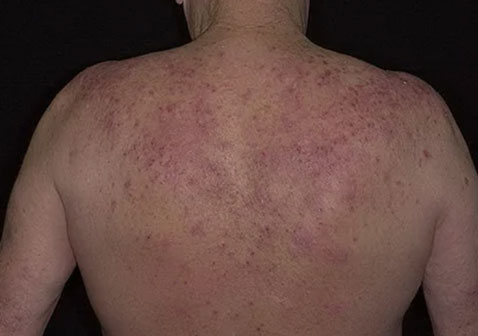 背部湿疹红斑症状图片