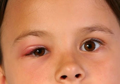 病毒性结膜炎眼睛肿胀图片