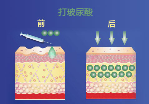 打玻尿酸前后对比图片