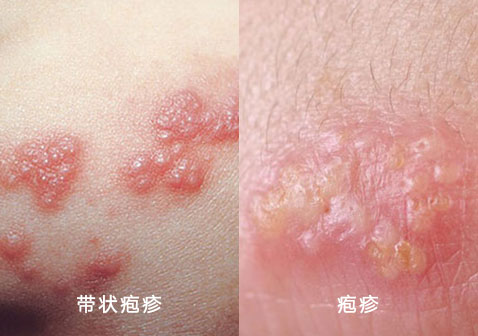 带状疱疹和疱疹的区别对比图片