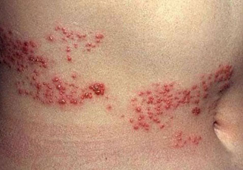 常见皮肤病图片及名称带状疱疹