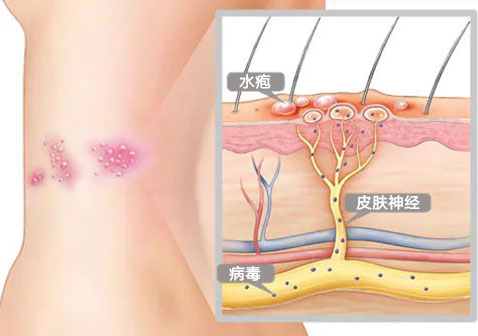带状疱疹形成过程图片