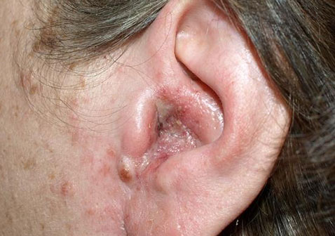 耳道湿疹症状图片