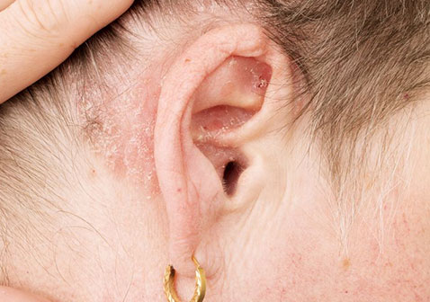 耳朵耳后湿疹症状图片