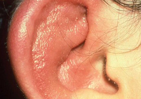 耳朵湿疹图片初期症状图片