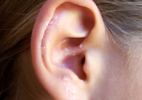 耳朵湿疹症状图片