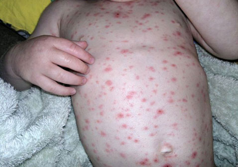 风疹图片和症状图片红色皮疹