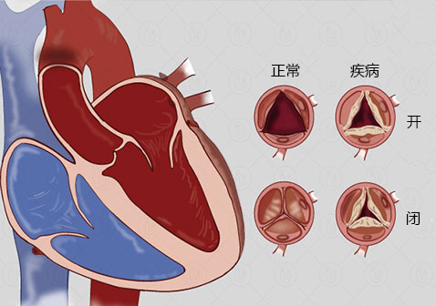 风湿性心脏病图片