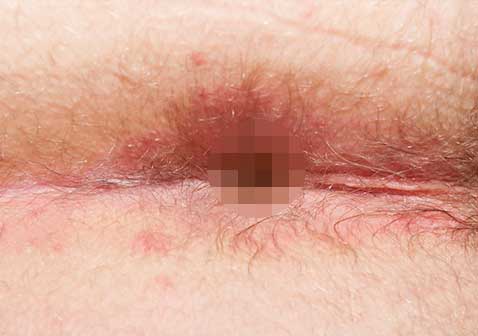 肛门慢性湿疹图片