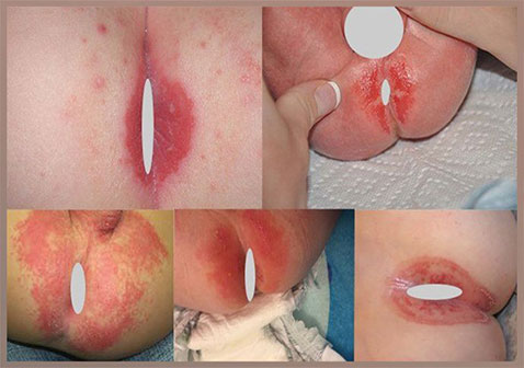 宝宝肛周湿疹图片和症状