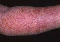湿疹红斑症状图片大全：胳膊、头皮、腿、后背
