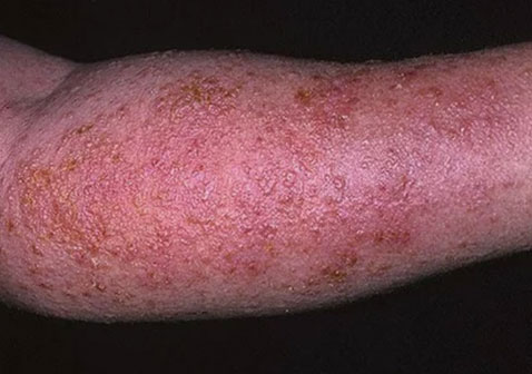 胳膊湿疹红斑症状图片