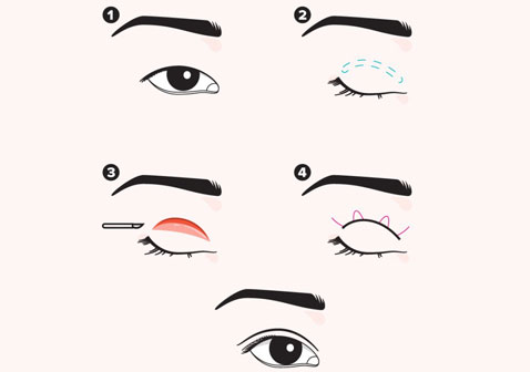 割双眼皮和埋线双眼皮做哪种好对比怎么做全过程图片