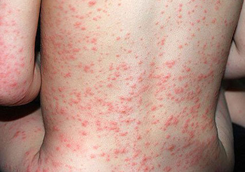 过敏性荨麻疹的症状和治疗图片