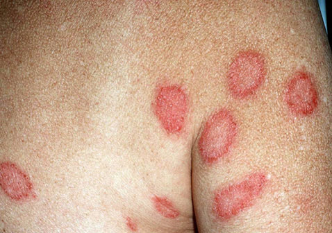 罕见皮炎性湿疹的症状图片