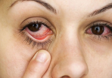 红眼病结膜炎一直不好怎么办