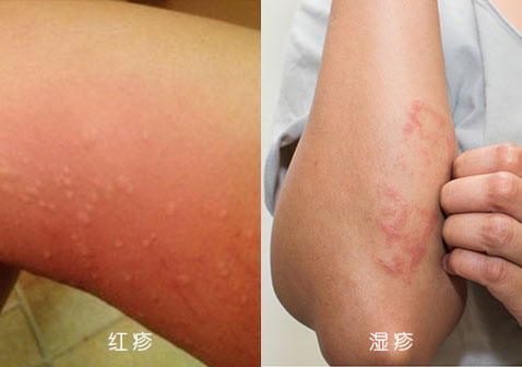 红疹和湿疹的区别对比图片