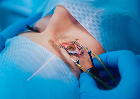 激光手术治疗近视和散光图片