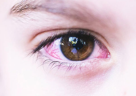 急性结膜炎眼睛图片