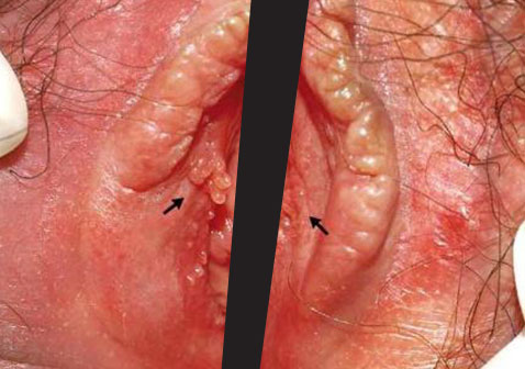 假性湿疣各种高清图片1