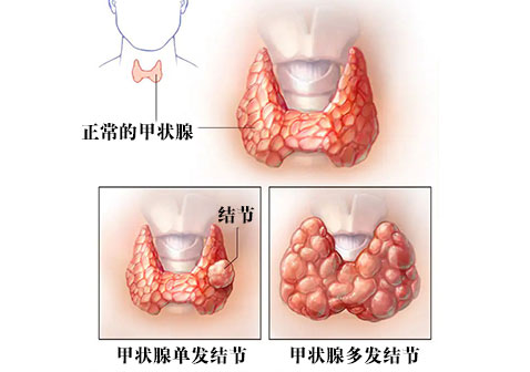 甲状腺结节图片