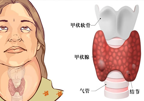 甲状腺结节怎么治疗